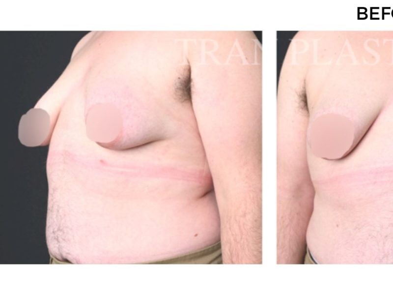 Procedure before and after - before