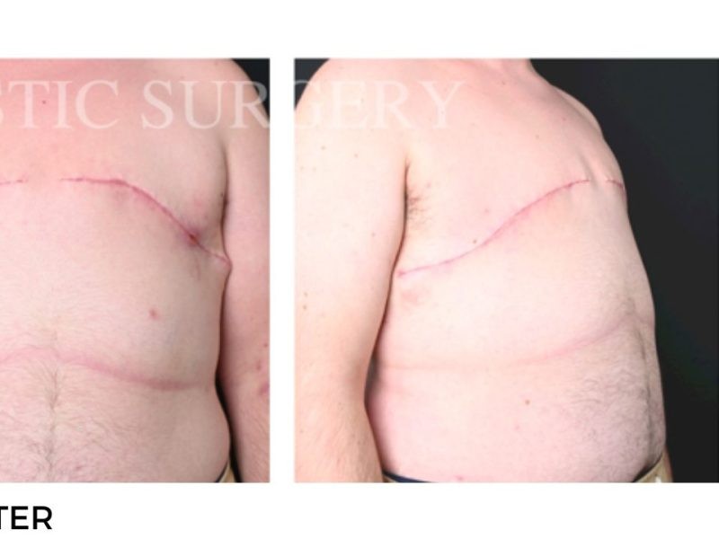 Procedure before and after - after