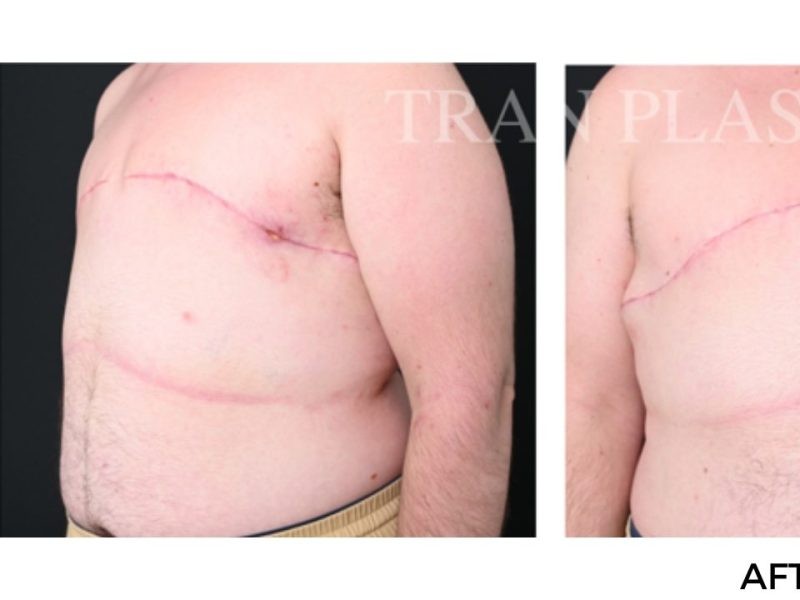 Procedure before and after - before