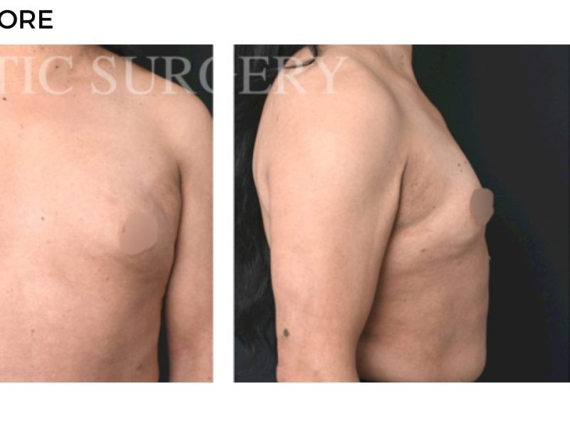 Procedure before and after - after