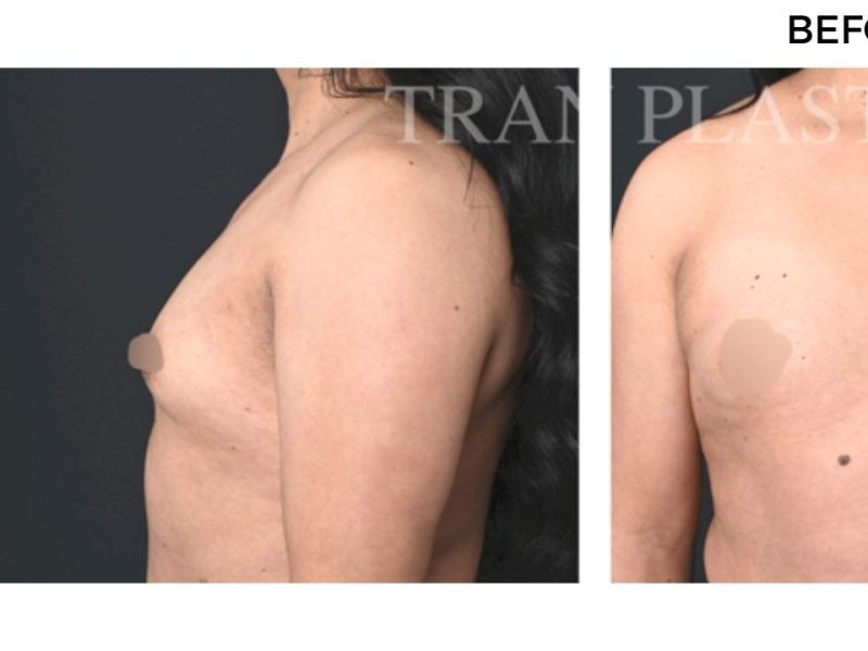 Procedure before and after - before