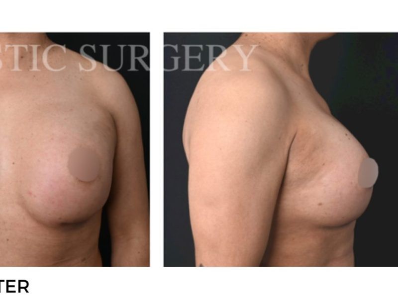 Procedure before and after - after