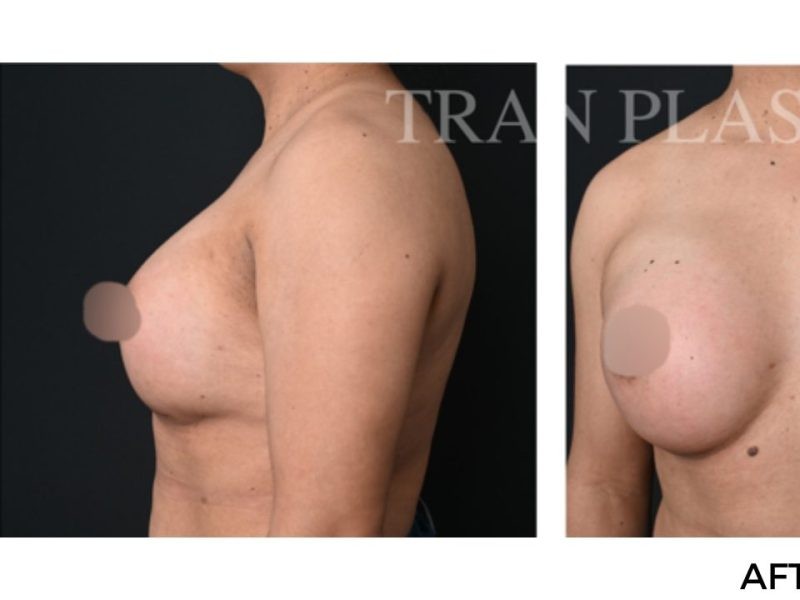 Procedure before and after - before