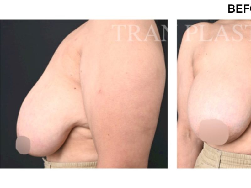 Procedure before and after - before