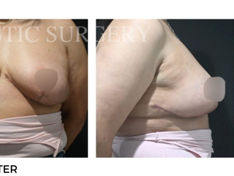 Procedure before and after - after