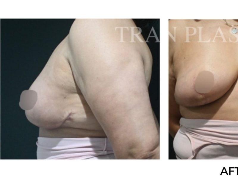 Procedure before and after - before