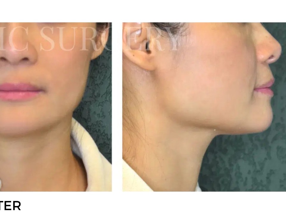 Procedure before and after - after