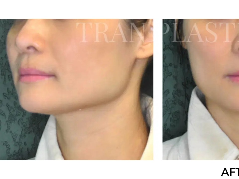Procedure before and after - before