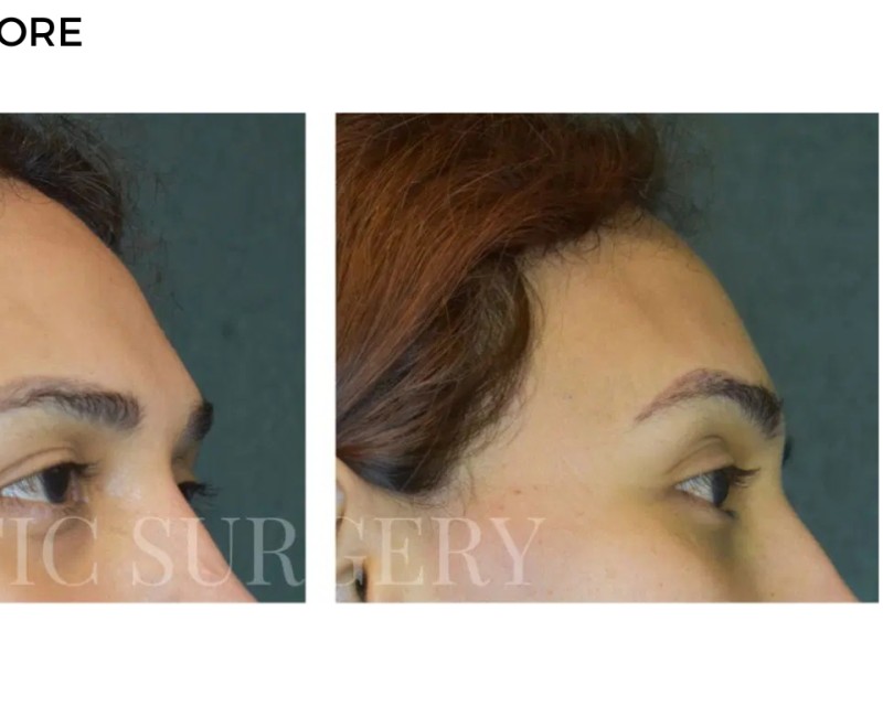 Procedure before and after - after