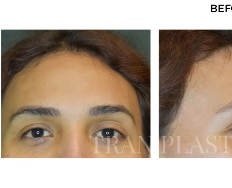 Procedure before and after - before