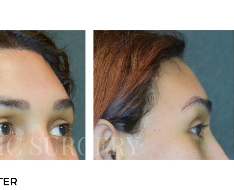 Procedure before and after - after