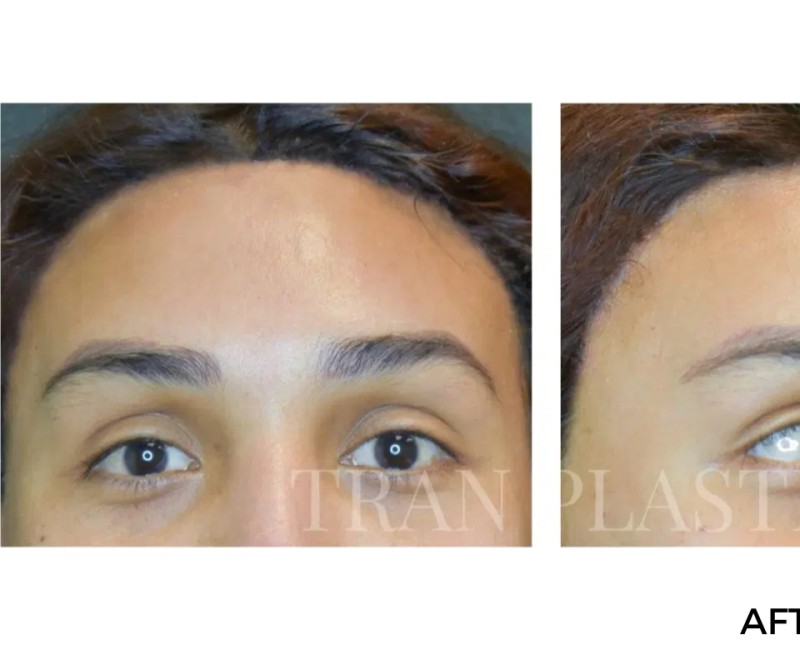 Procedure before and after - before