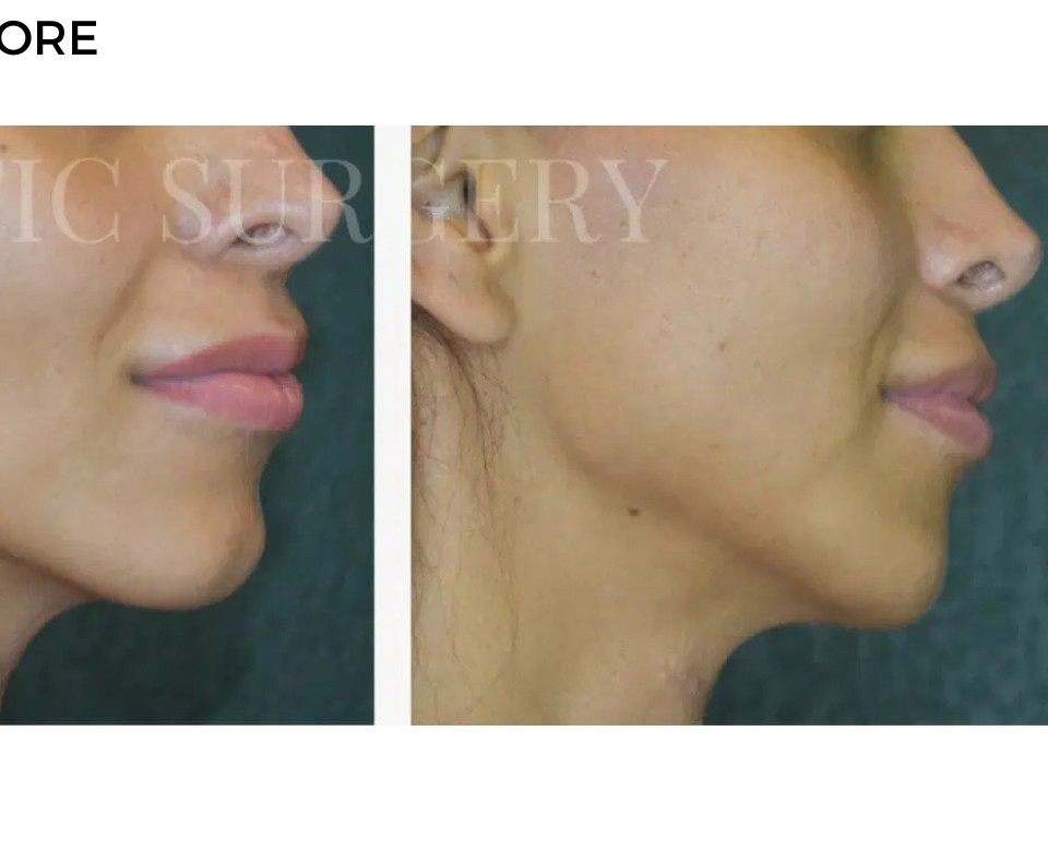 Procedure before and after - after