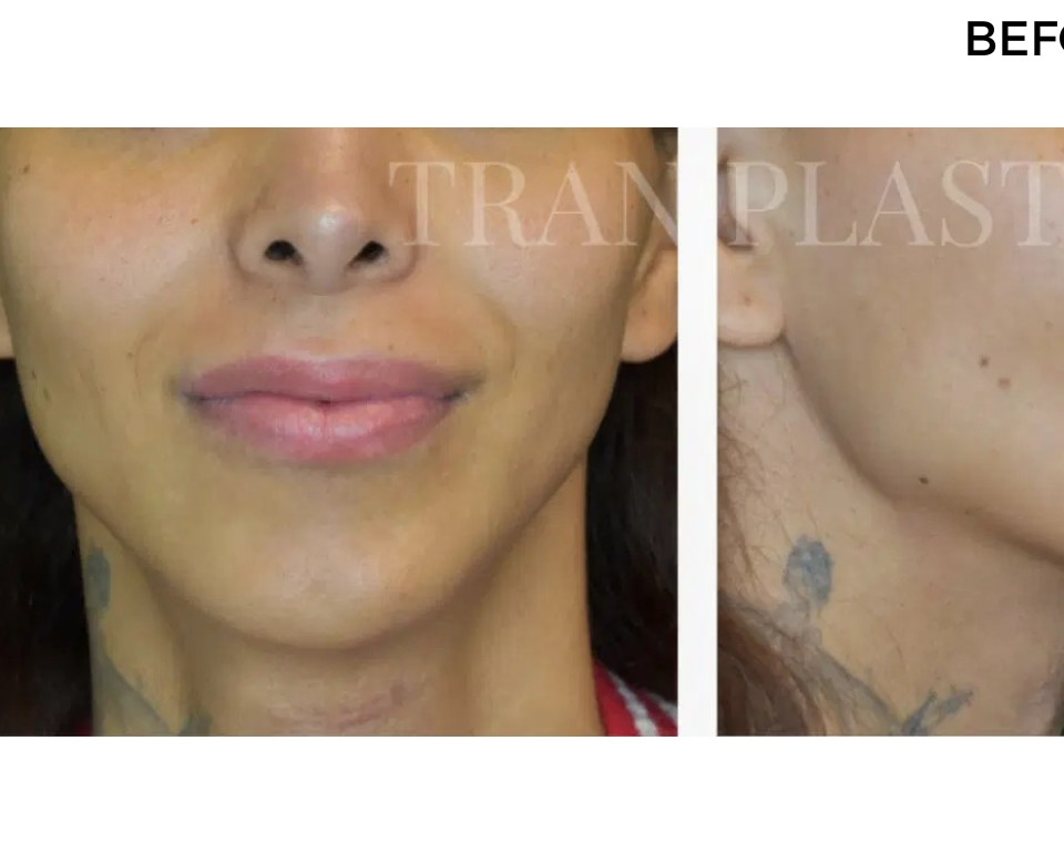 Procedure before and after - before
