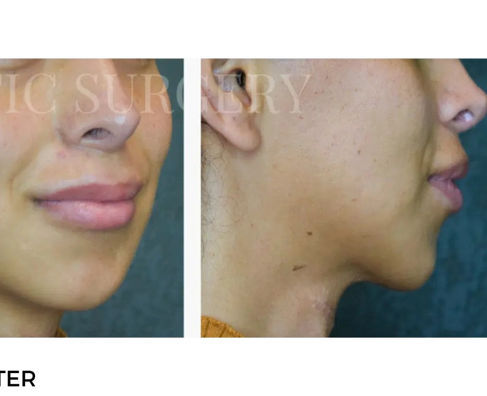 Procedure before and after - after