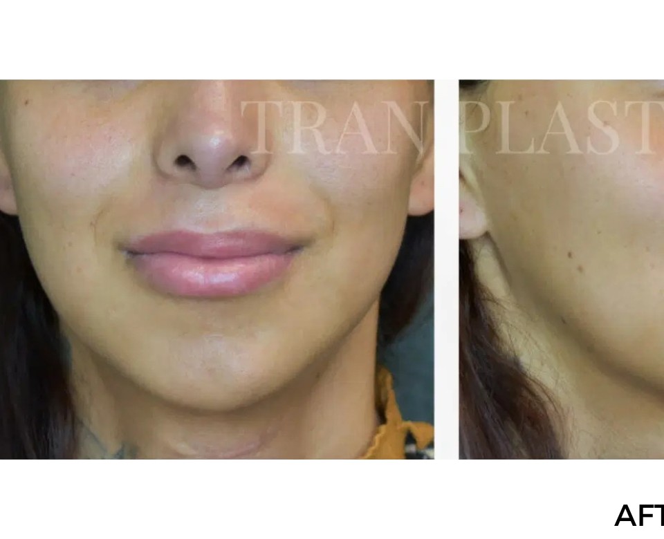 Procedure before and after - before