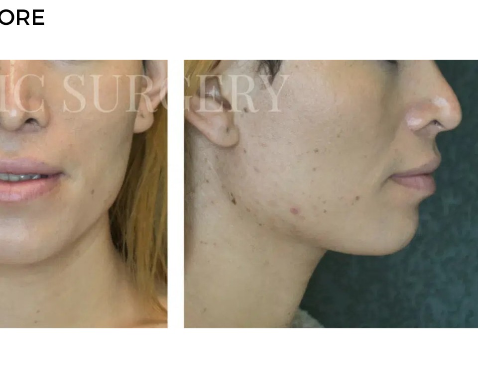 Procedure before and after - after