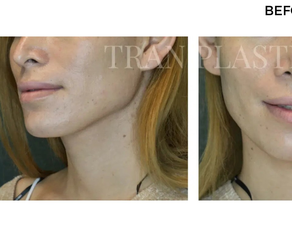 Procedure before and after - before