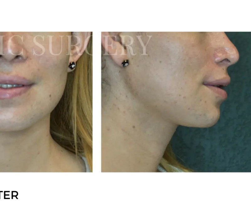 Procedure before and after - after