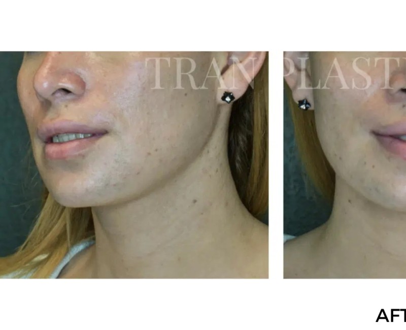 Procedure before and after - before