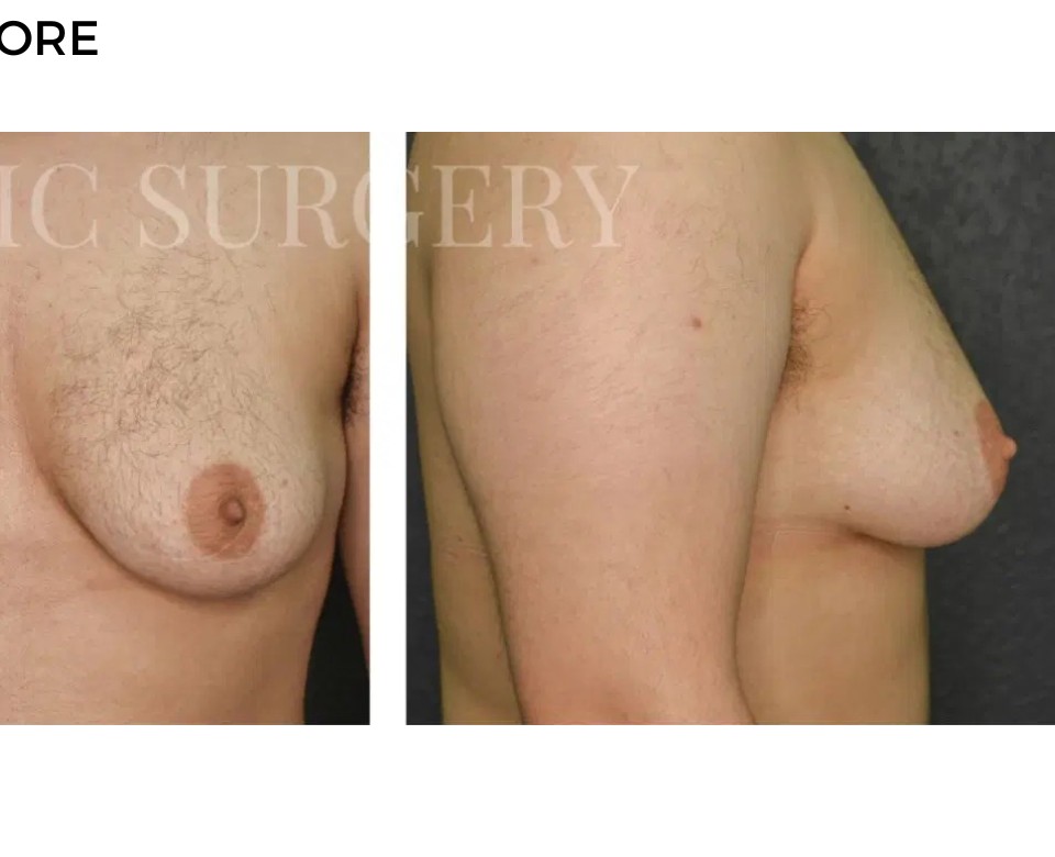 Procedure before and after - after