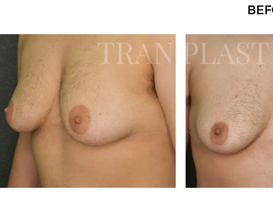 Procedure before and after - before