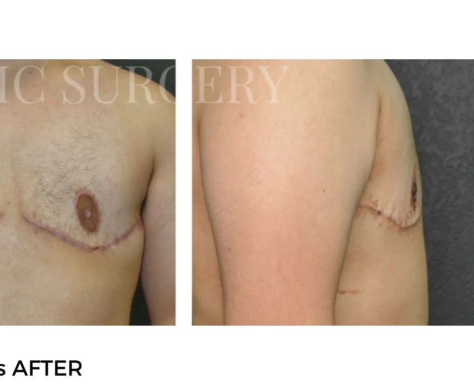 Procedure before and after - after