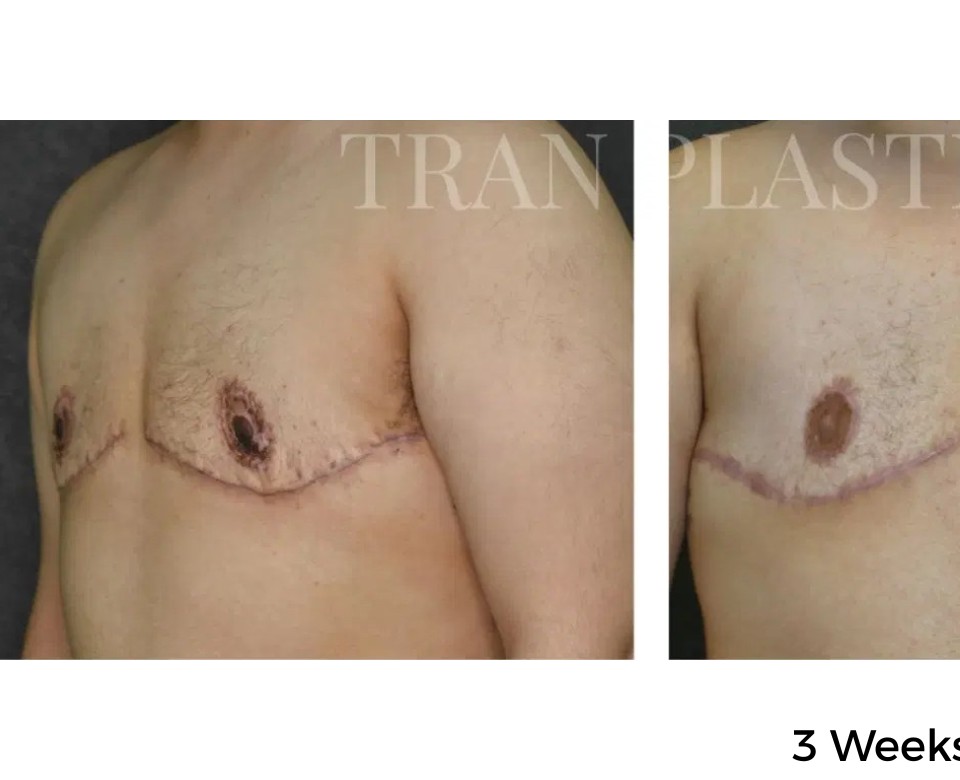 Procedure before and after - before