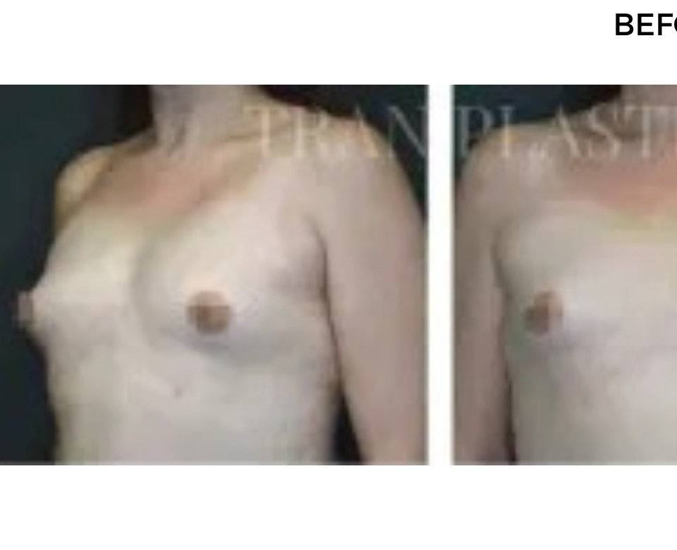 Procedure before and after - before