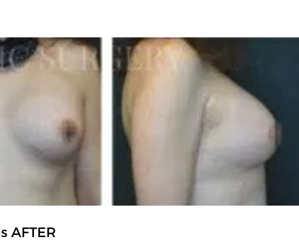 Procedure before and after - after