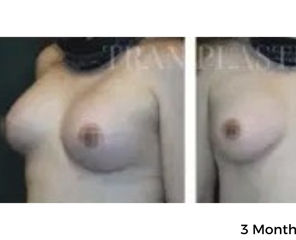 Procedure before and after - before