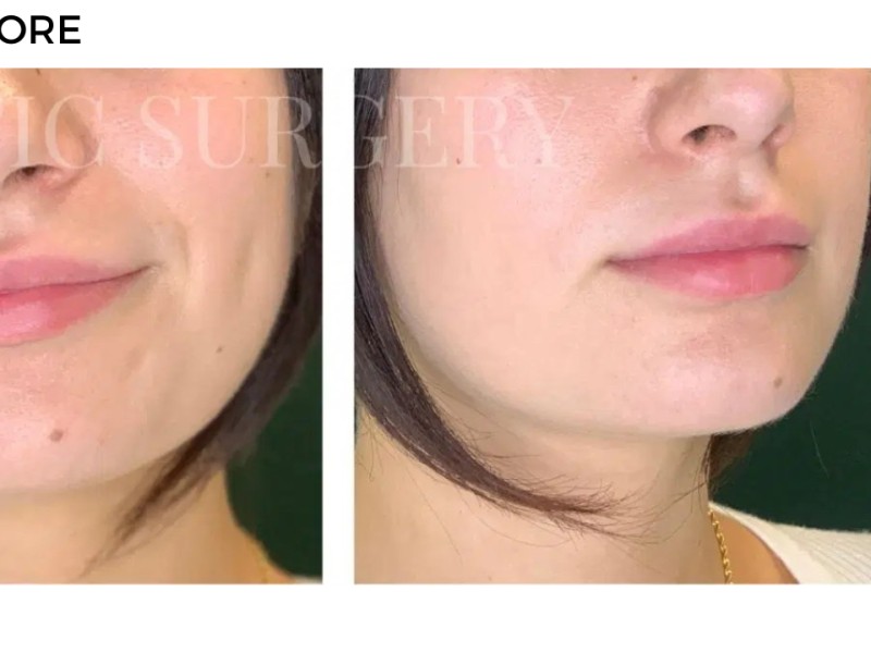 Procedure before and after - after