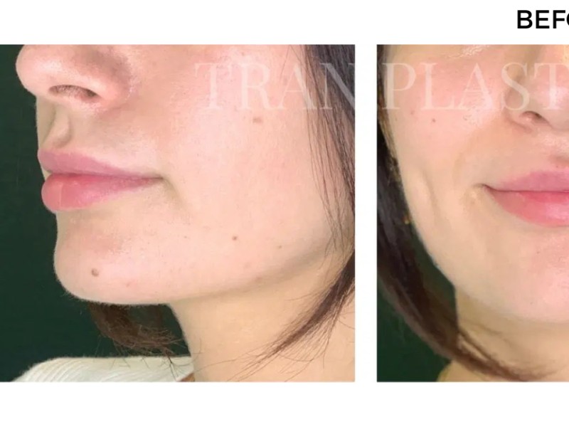 Procedure before and after - before