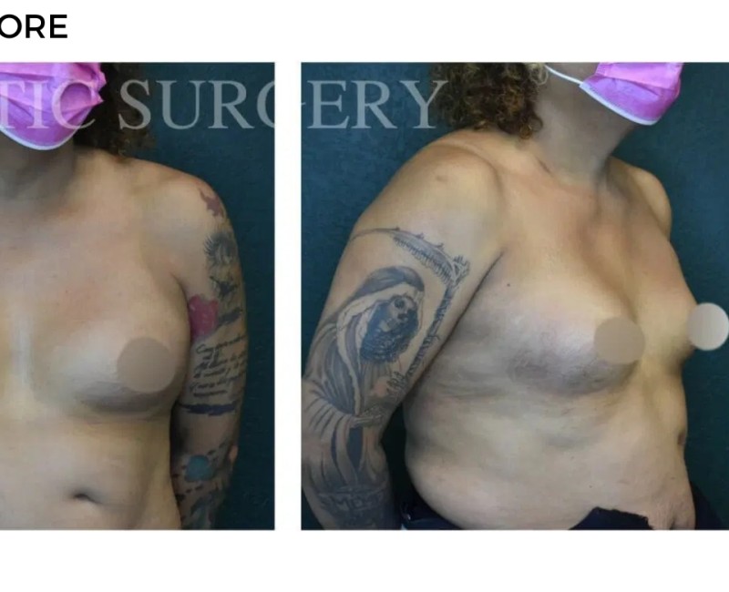 Procedure before and after - after