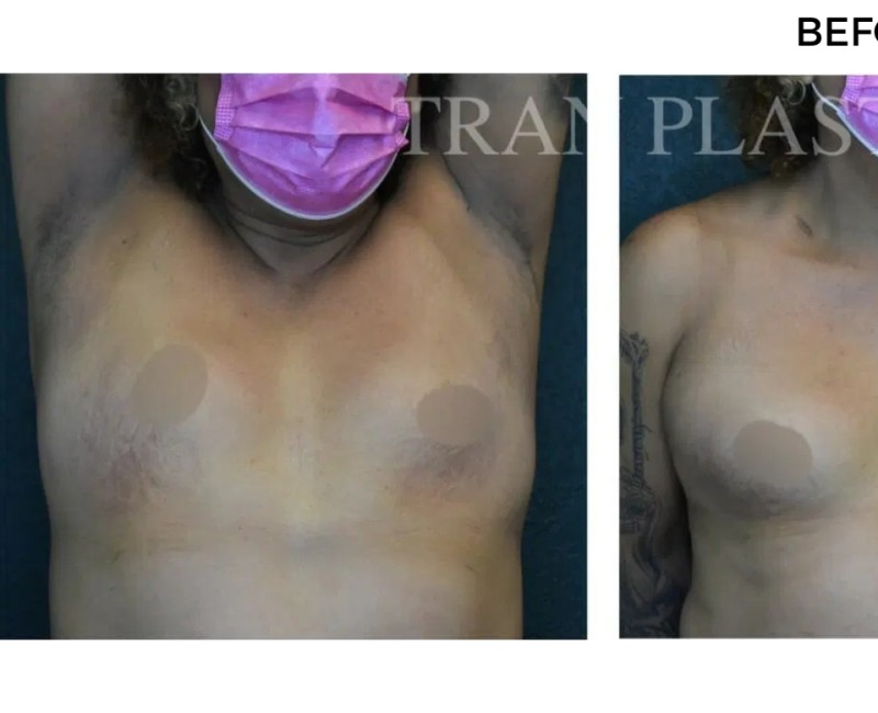 Procedure before and after - before