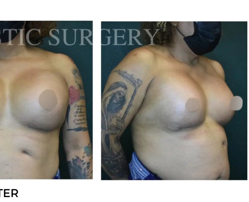 Procedure before and after - after
