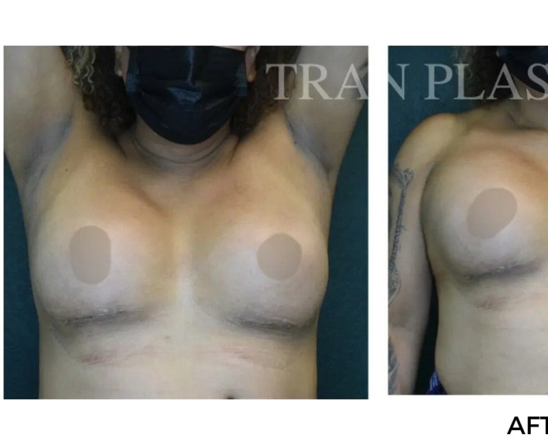 Procedure before and after - before