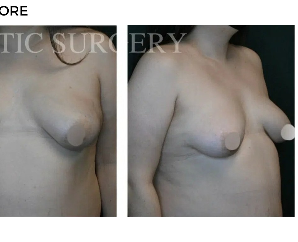 Procedure before and after - after