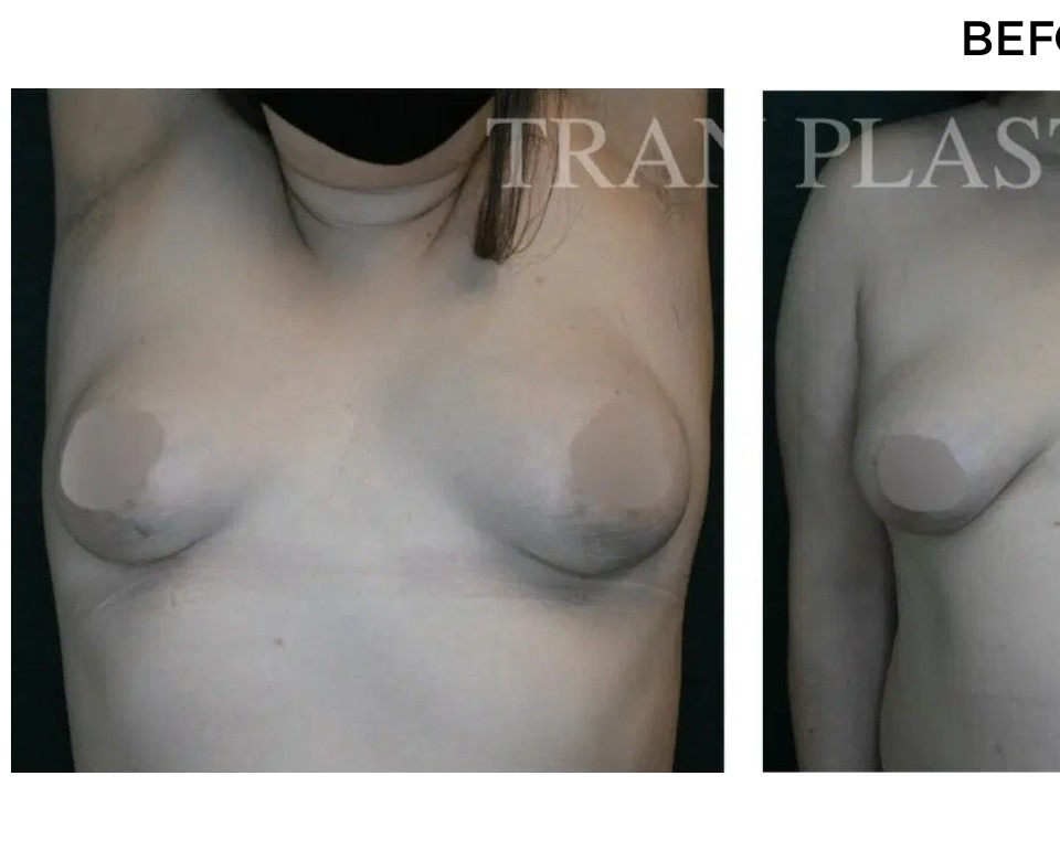 Procedure before and after - before