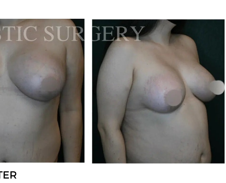 Procedure before and after - after