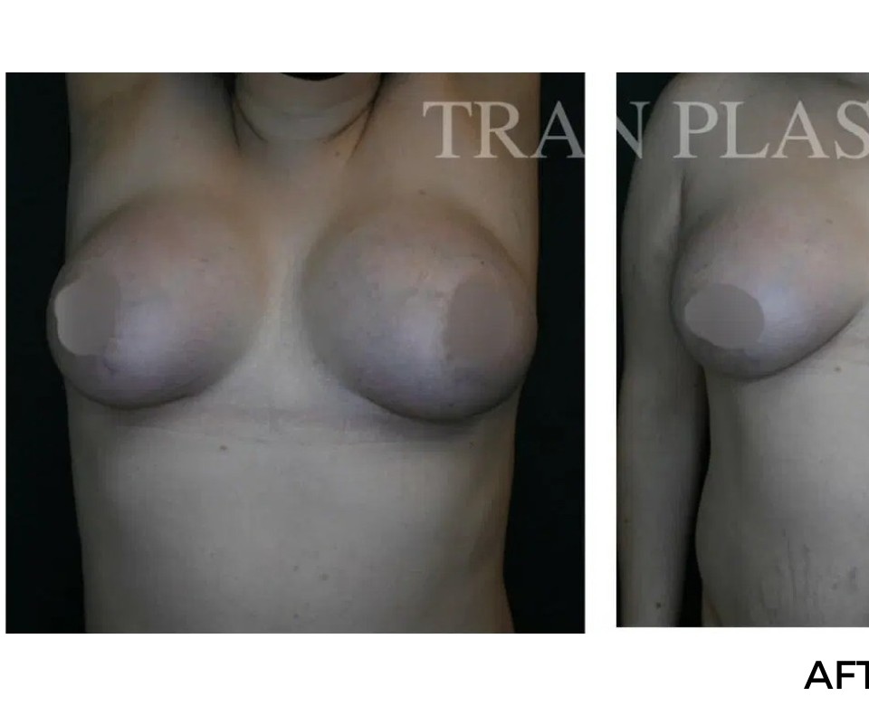 Procedure before and after - before