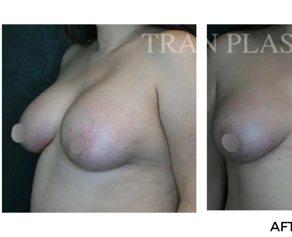 Procedure before and after - before