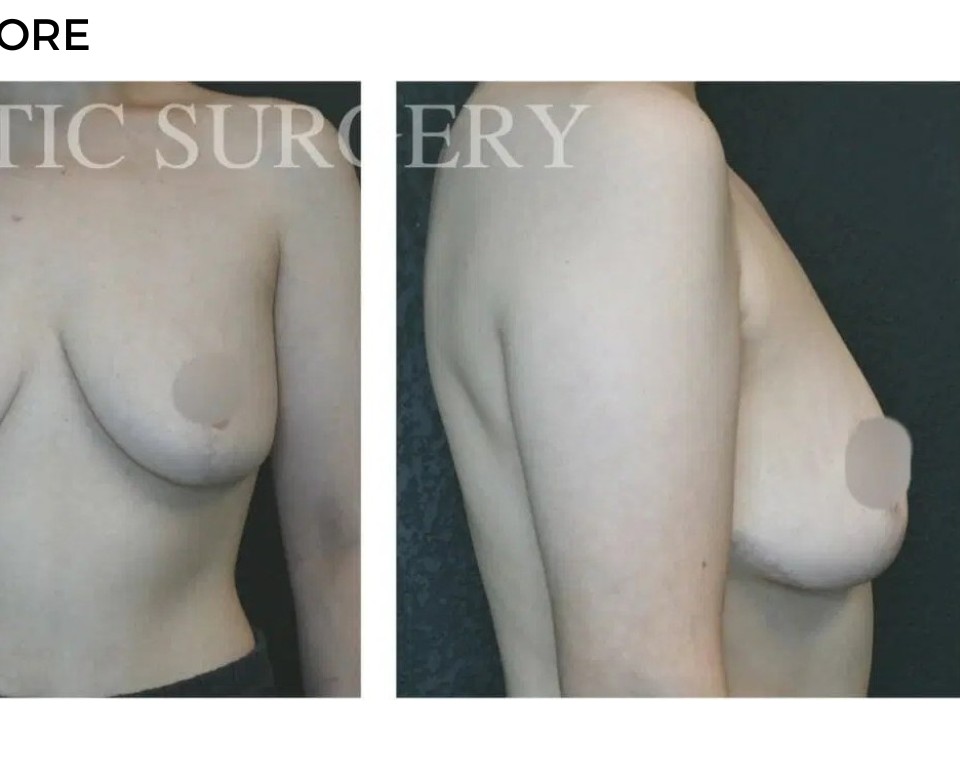 Procedure before and after - after