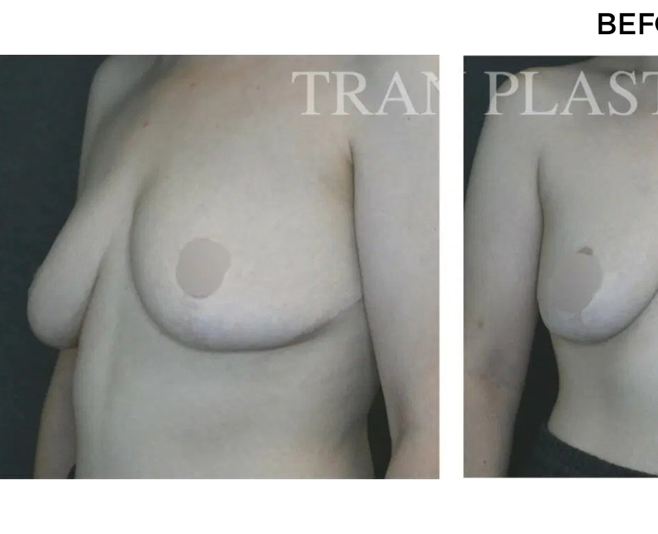 Procedure before and after - before