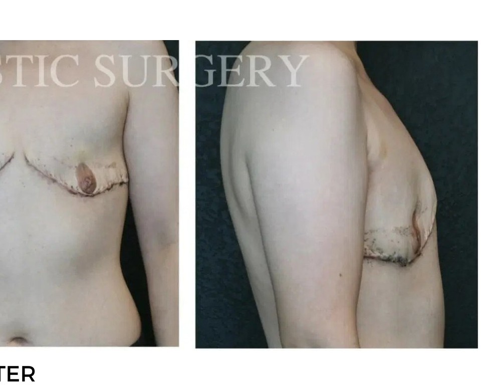 Procedure before and after - after