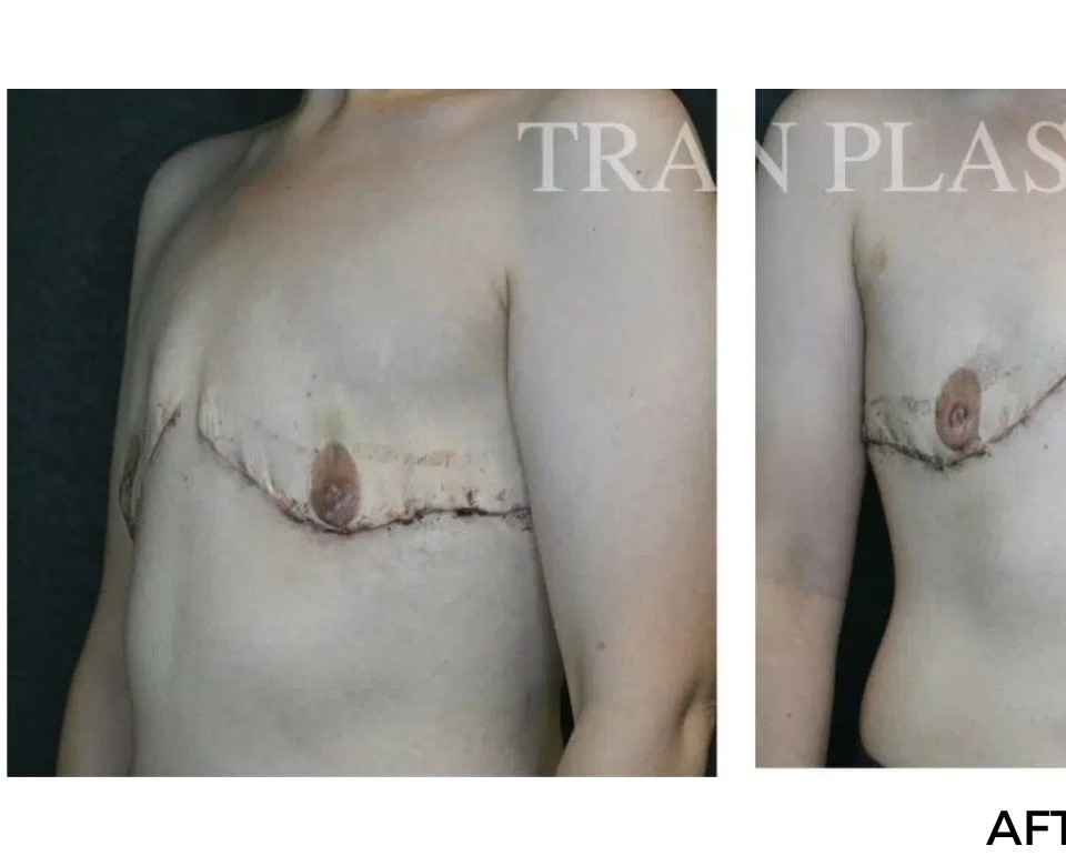 Procedure before and after - before