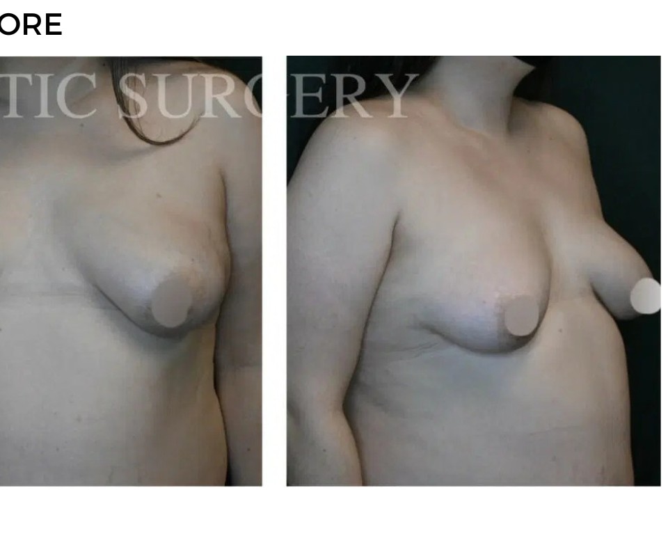 Procedure before and after - after