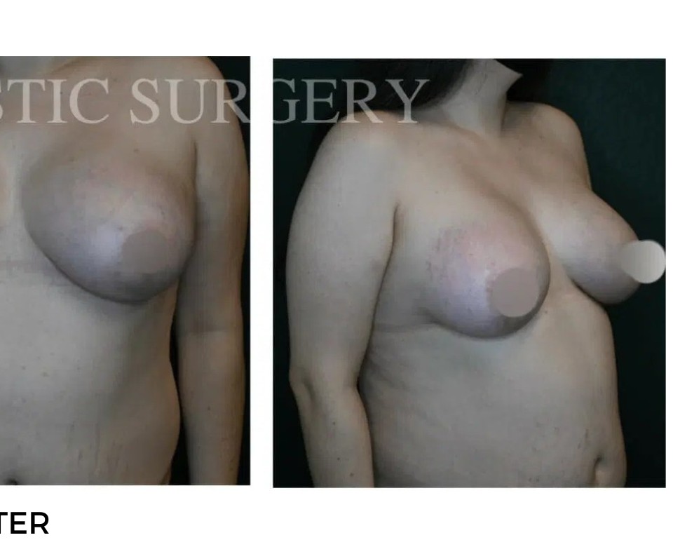 Procedure before and after - after