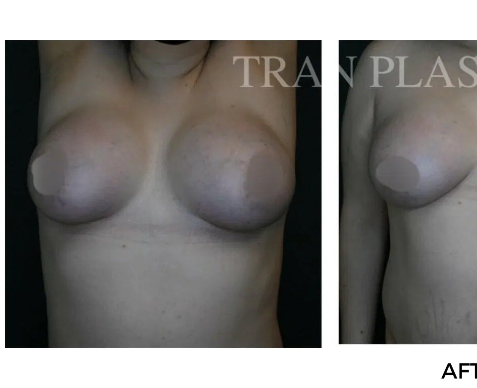 Procedure before and after - before