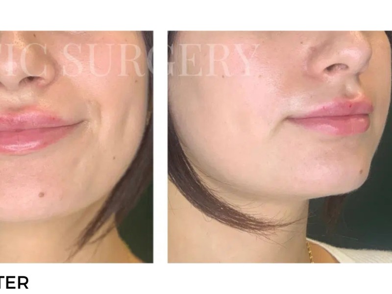 Procedure before and after - after